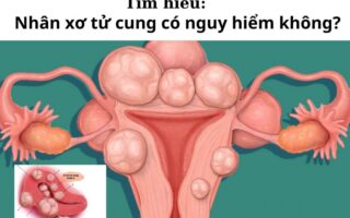 Nhân xơ tử cung có nguy hiểm không