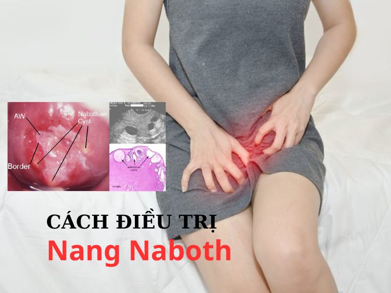 Cách điều trị nang naboth cổ tử cung