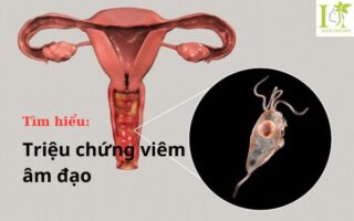 Triệu chứng viêm âm đạo