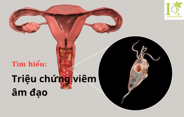 Triệu chứng viêm âm đạo