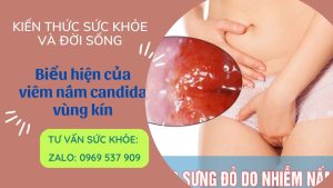 Biểu hiện của viêm nấm candida