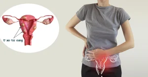 Nhân xơ tử cung là gì?