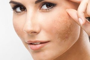 thiếu hụt collagen