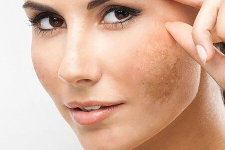 thiếu hụt collagen