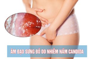 Triệu chứng viêm âm đạo do nấm candida