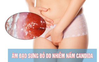 Triệu chứng viêm âm đạo do nấm candida