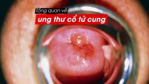 Ung thư cổ tử cung