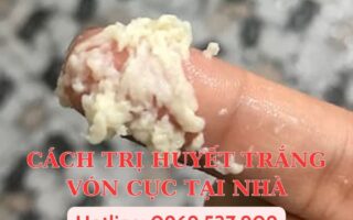 CÁCH TRỊ HUYẾT TRẮNG VÓN CỤC TẠI NHÀ
