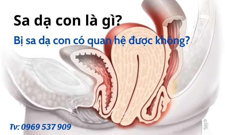 Bị sa dạ con có quan hệ được không?