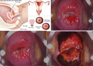 Hình ảnh thực tế viêm lộ tuyến độ 3