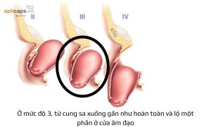các cấp độ sa tử cung
