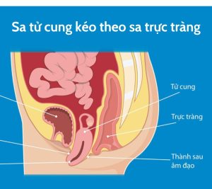 Sa tử cung kéo theo sa trực tràng