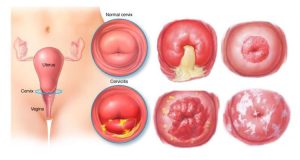 viêm lộ tuyến cổ tử cung