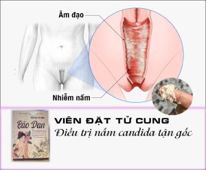 VIÊN ĐẶT ĐÔNG Y TRỊ NẤM NGỨA TẬN GỐC