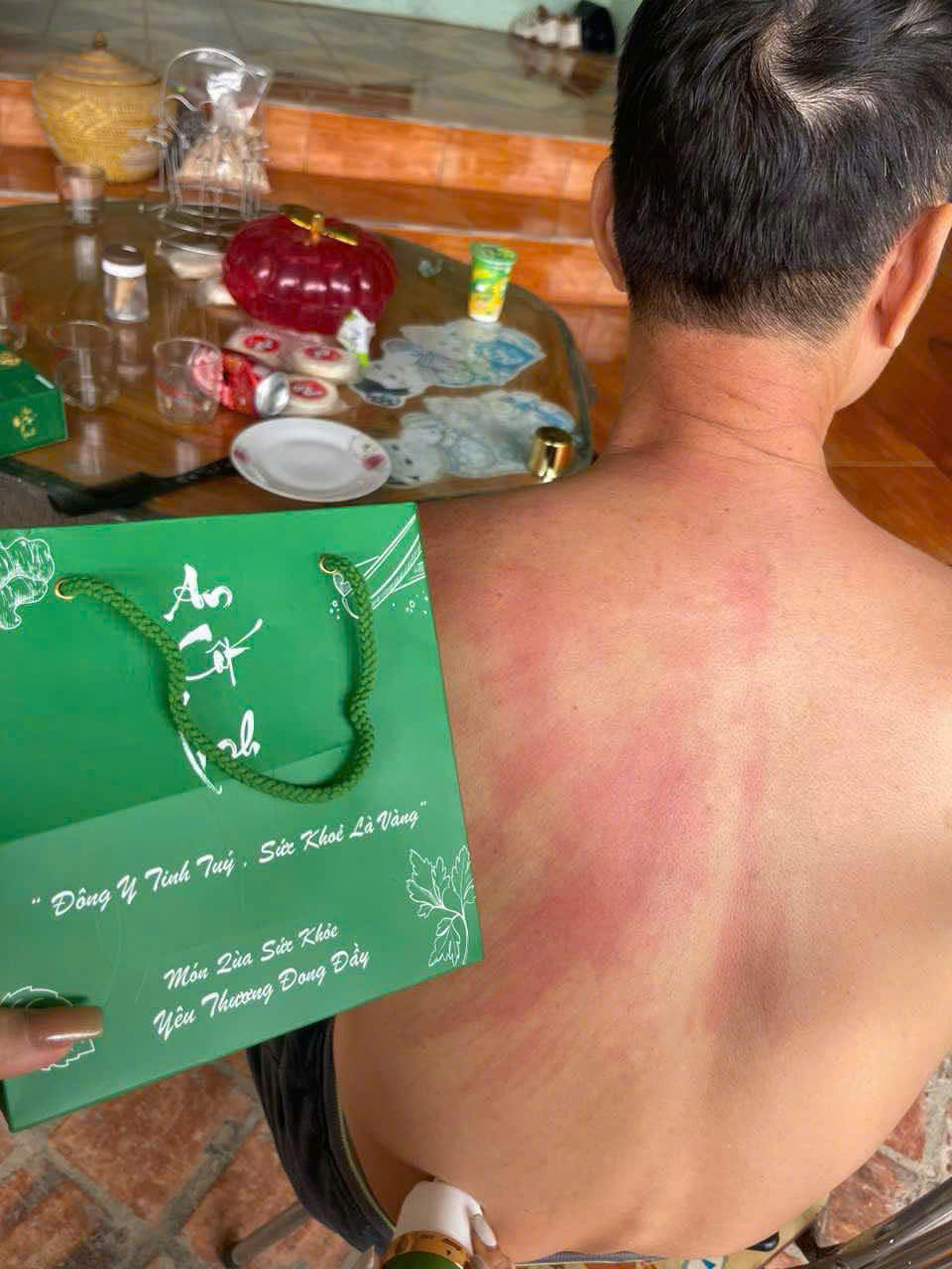 An cốt linh hiệu quả giảm cơn đau nhanh chóng